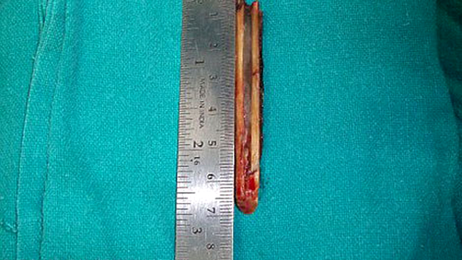 Cu acest bat a trait micutul Rahul, in cap, timp de doi ani!