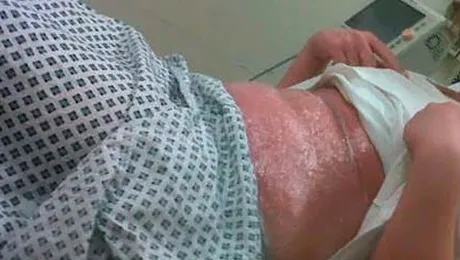 O minoră a ajuns la spital cu pielea arsă de solar