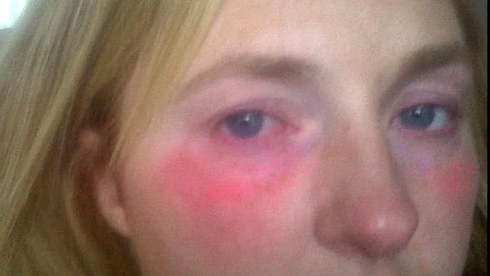 Katie Dell, femeia alergica la propriile lacrimi