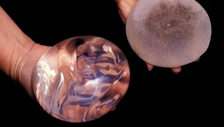 Cum s-a ratacit un implant cu silicon in corpul unei femei