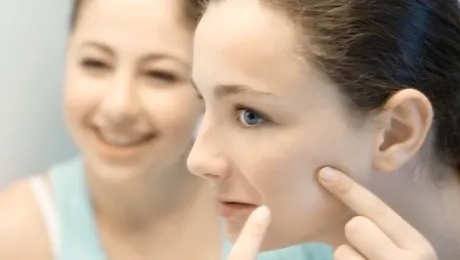 Acnee: cauze si tratament!