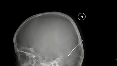 O fetita de sapte ani a supravietuit unei impuscaturi in cap
