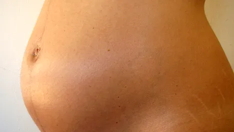 3 remedii naturale care tratează vergeturile