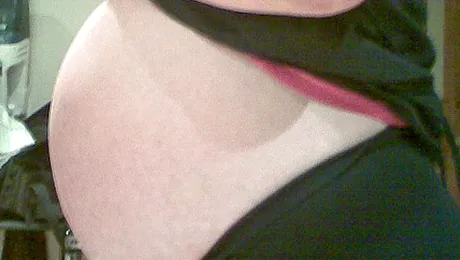 Femeia cu un chist ovarian de 6 kg credea ca este gravida