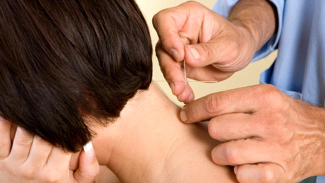 acupunctura