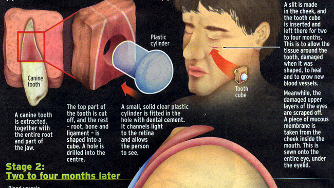 stadii implant dinte in ochi