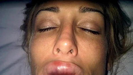 Model desfigurat de o injecție pentru mărirea buzelor