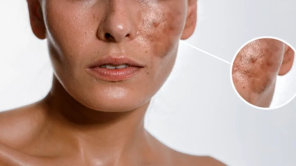 (P) Melasma: de ce apar petele maronii, cum le tratăm și cum le prevenim