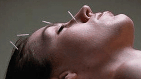 Acupunctura te ajuta sa slabesti