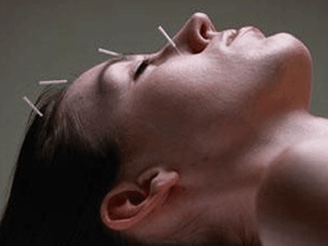 Acupunctura te ajuta sa slabesti