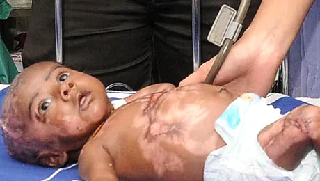 Bebelușul care ia foc singur