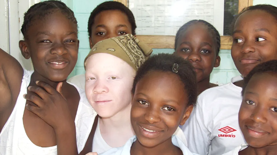 Albinosii din Tanzania, masacrati de dragul vrajitoriei