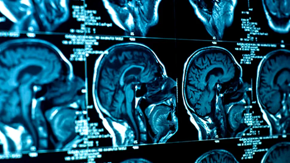 A fost identificată regiunea cerebrală responsabilă de instalarea schizofreniei și bolii Alzheimer
