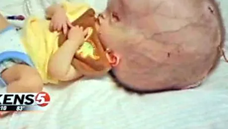 Socant! Un bebelus de 10 luni are capul de doua ori mai mare decat unul normal