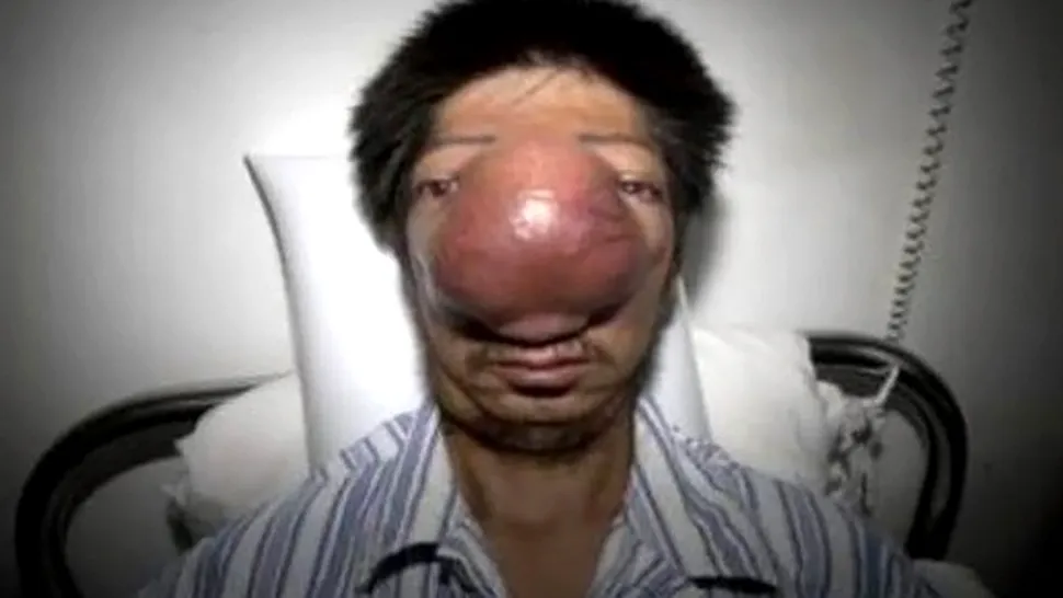 Un chinez desfigurat de cancer a socat medicii