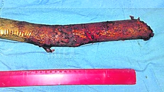 lemnul scos din pieptul femeii