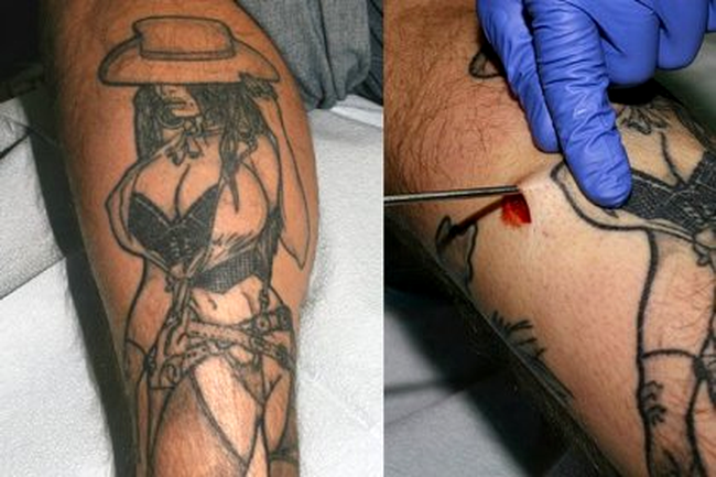 Implant de silicoane pentru un tatuaj
