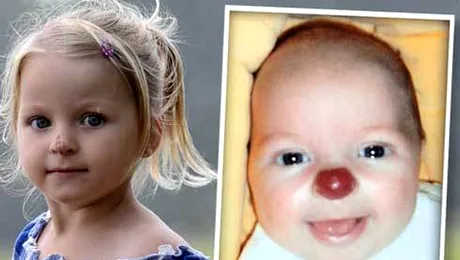 Connie, fetita care s-a nascut cu nas de clovn