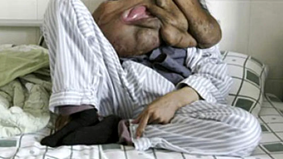 SOCANT: Desfigurat de o tumoare de 23 de kilograme (Video)