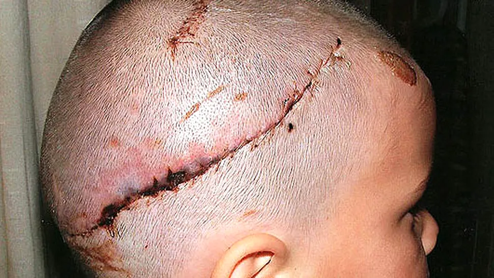 SOCANT: Un baietel a fost scalpat de un rottweiler! (Poze)