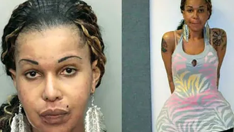 O femeie a primit injectii cu ciment si super-glue pentru marirea feselor