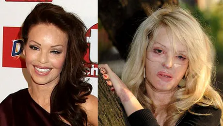 Katie Piper si-a revenit dupa ce a fost desfigurata cu acid sulfuric!
