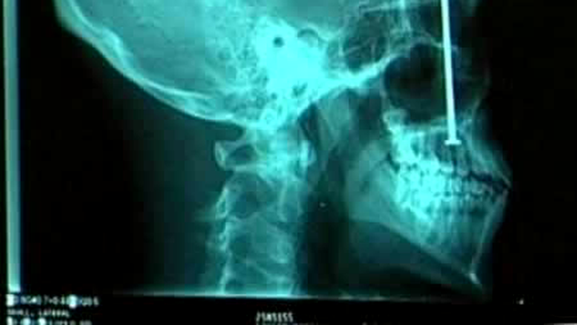 x ray