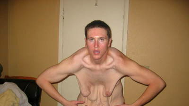 david smith, inainte de operatia de indepartare a excesului de piele