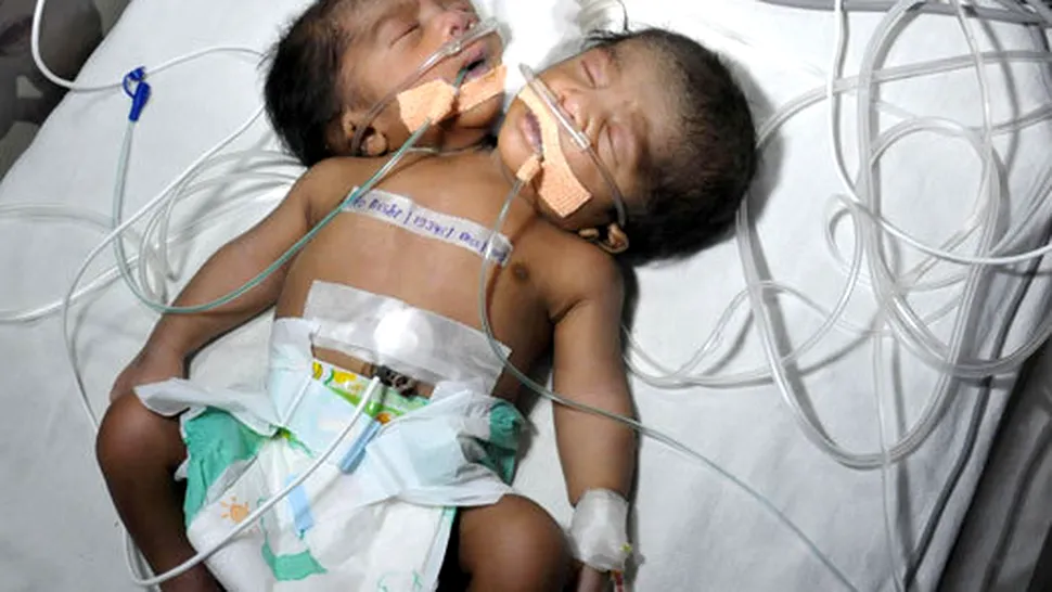 Un copil cu două capete a fost născut în India