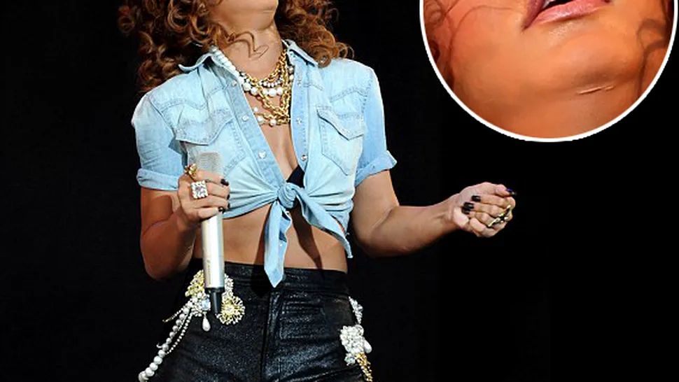 Rihanna si-a facut operatie estetica pentru a scapa de gusa?