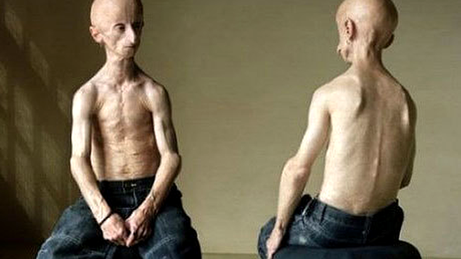 Leon Botha - "omul extraterestru"