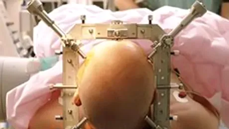 Maladia Alzheimer ar putea fi tratata