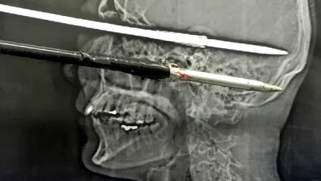 A supraviețuit după ce și-a înfipt accidental o săgeată în cap