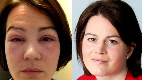 A vrut să fie mai frumoasă dar și-a distrus fața înainte de ziua nunții