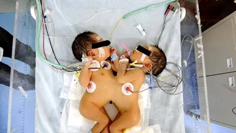 Siameze nascute la Pitesti: Au inimi separate, dar ficat comun