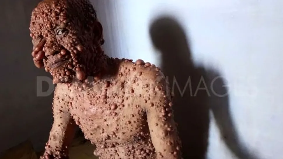 Boala rară care a desfigurat un bărbat din Indonezia