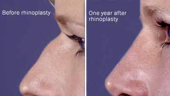 Rinoplastie