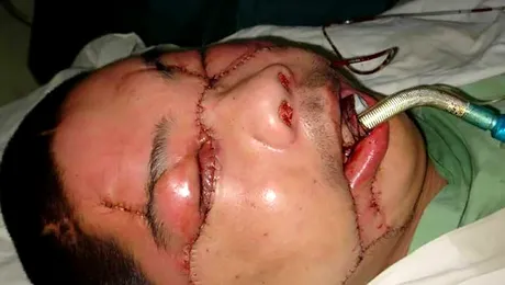 Primul transplant facial complet, realizat in Franta