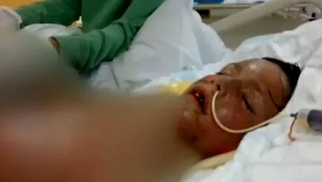 Pastila pentru răceală i-a provocat arsuri pe 65% din suprafața corpului (Video)