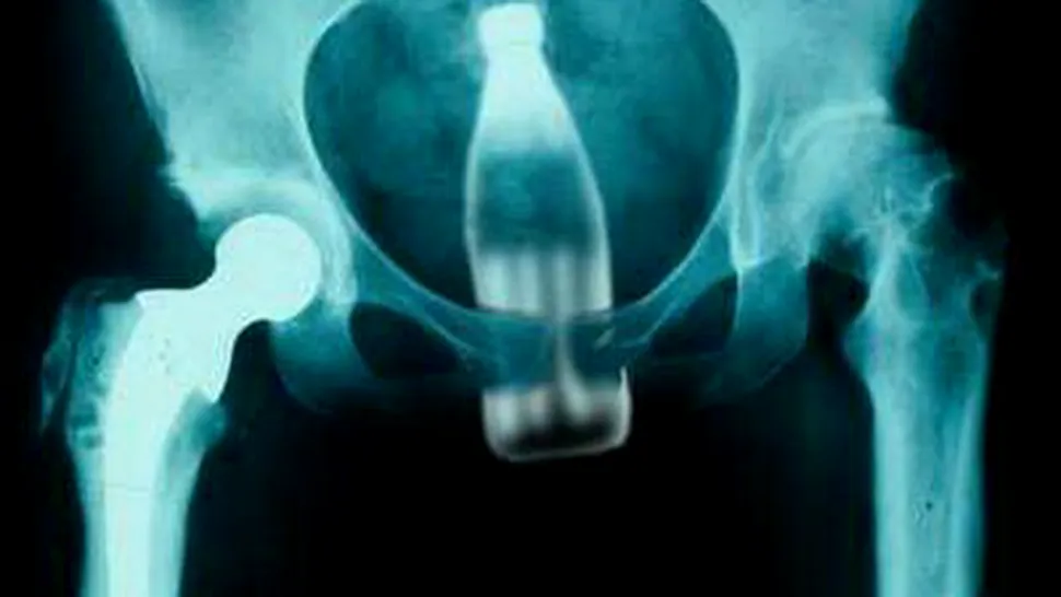 Cele mai ciudate obiecte descoperite la radiografii (Poze)