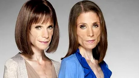 Gemenele care la 33 de ani cantaresc doar 31 de kilograme