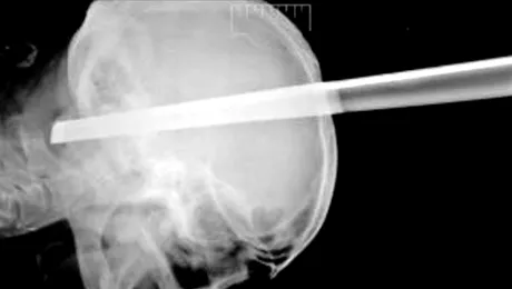 A supraviețuit după ce piciorul unui scaun i-a străpuns craniul