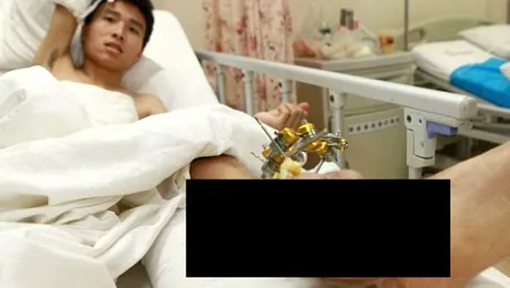 Metoda incredibilă prin care medicii au salvat mâna unui bărbat