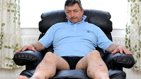 S-a îmbolnăvit de la un fotoliu cumpărat de pe internet