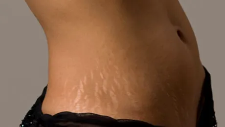 10 remedii naturiste pentru vergeturi