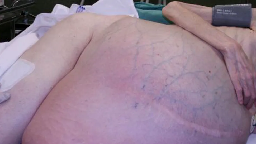Medicii au operat o femeie din cauza unei tumori de 60 de kilograme