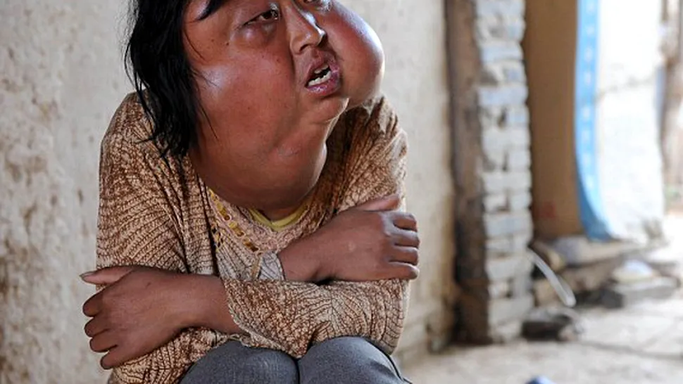 Femeie desfigurată din cauza a șapte tumori faciale (FOTO)