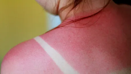 Cele mai bune 6 soluții împotriva arsurilor cauzate de soare