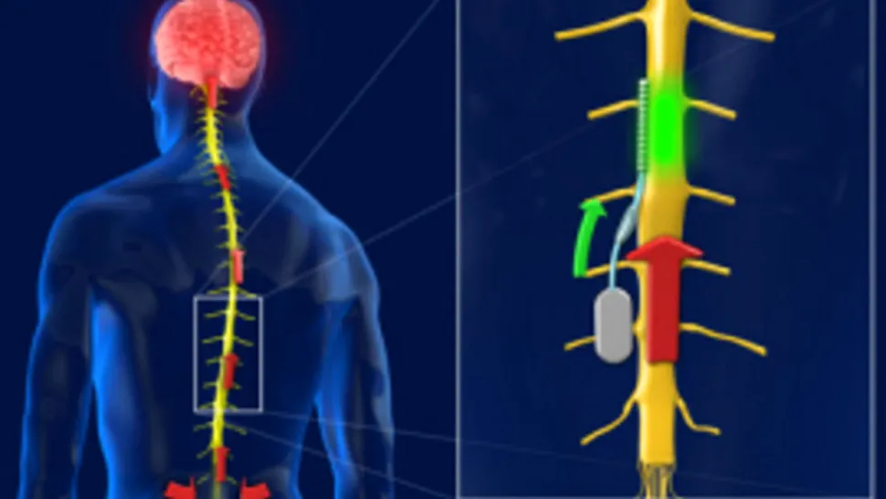 Un cip implantat in coloana vertebrala ar putea ajuta pacientii cu dureri cronice