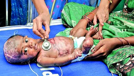 Un nou născut indian suferă de Combustie umană spontană